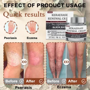 Flash Sale: KeraErase Dual-Action Renewal Cream - Image 2