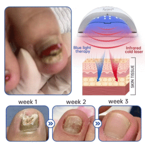 PureNail Fungus Laser Device - Image 2
