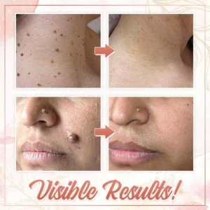 Herbal Wart Skin Removal Ointment - Image 11