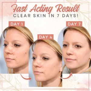 Herbal Wart Skin Removal Ointment - Image 4