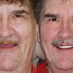 Advanced Customized Full Denture Set - Image 10