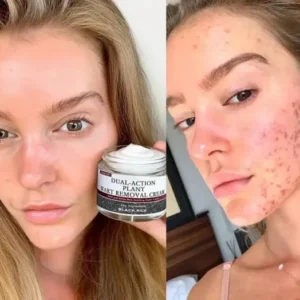 Black Rice Skin Repair Cream – Clinically Tested Wart & Skin Tag Remover - Image 5
