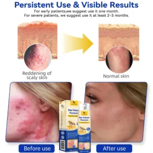 PsoriaHeal psoriasis Spray pro - Image 3