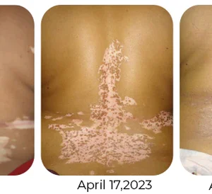 Vitiligo Therapy Cream - Image 8