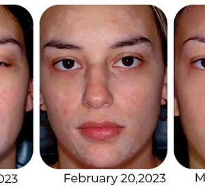Vitiligo Therapy Cream - Image 7