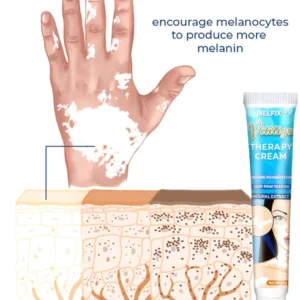 Vitiligo Therapy Cream - Image 2