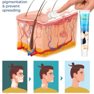 Vitiligo Therapy Cream - Image 3