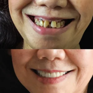 BioFusion Dentures - Image 8