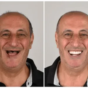 Custom-Fit Functional Dentures Smile with Confidence - Image 7