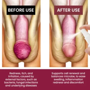 Balanitis Treatment Spray - Image 2