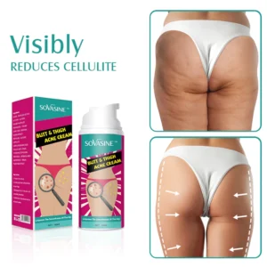 Butt & Thigh Acne Cream - Image 3