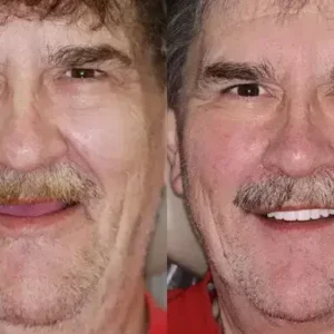 SmileFitPro Premium Denture - Image 10