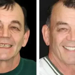 SmileFitPro Premium Denture - Image 11