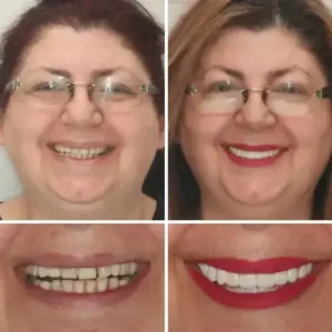 SmileFitPro Premium Denture - Image 7