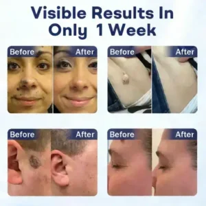Mole and Wart Removal Cream - Image 2