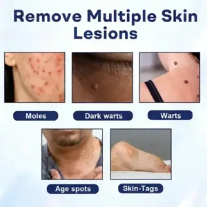 Mole and Wart Removal Cream - Image 3