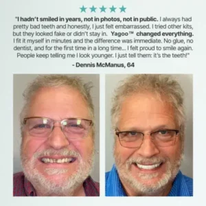 Custom Custom-Fit Full Functional Dentures - Image 6