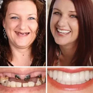 – Medical Full Denture with Strong Suctiond - Image 10