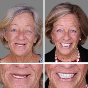 Medical Full Denture with Strong Suctiond - Image 10