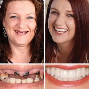 Medical Full Denture with Strong Suctiond - Image 12