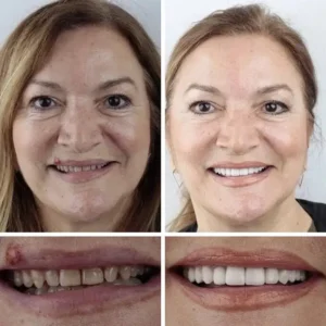 Medical Full Denture with Strong Suctiond - Image 13