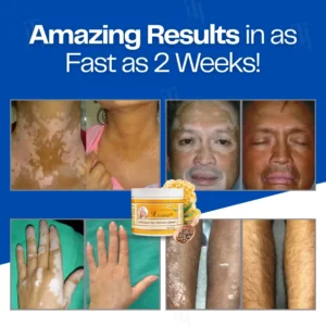 VitiClear Bee Venom Cream | No More Hiding that Skin! - Image 2