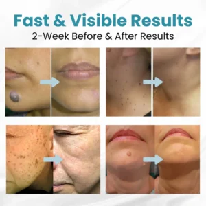 non-invasive laser pen delivers hospital-grade results at home - Image 2