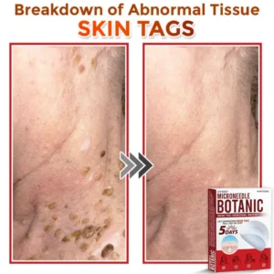 MicroNeedle Botanic Skin Tag Removal Patch - Image 7