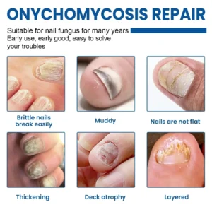 Fungus Nail Repair Patches - Image 3