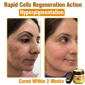 𝐁𝐞𝐞 𝐏𝐨𝐢𝐬𝐨𝐧 𝐀𝐥𝐥-𝐢𝐧-𝐎𝐧𝐞 𝐂𝐫𝐞𝐚𝐦–🌸 Anti-aging,Hydrating, Skin Repair, Even Tone, Acne and Dark Spot Treatment, Wart and Mole Removal, Psoriasis Relief - Image 11