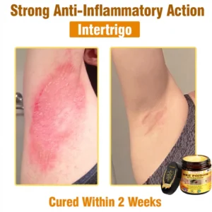 𝐁𝐞𝐞 𝐏𝐨𝐢𝐬𝐨𝐧 𝐀𝐥𝐥-𝐢𝐧-𝐎𝐧𝐞 𝐂𝐫𝐞𝐚𝐦–🌸 Anti-aging,Hydrating, Skin Repair, Even Tone, Acne and Dark Spot Treatment, Wart and Mole Removal, Psoriasis Relief - Image 13