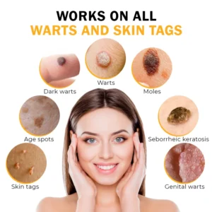 FlawlessFix Mole & Wart Removal Cream - Image 5