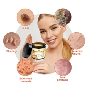 Bee Venom Mole and Wart Treatment Cream - Image 8