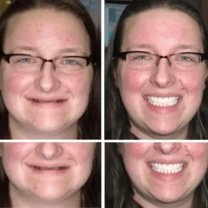 Custom-Fit Functional Dentures - Image 4