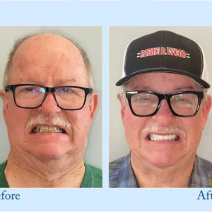 Custom-Fit Functional Dentures - Image 15