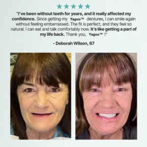 💗Ends Today: 70% OFF! Custom Custom-Fit Full Functional DenturesMake you more confident - Image 10