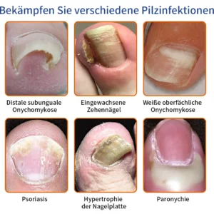 Bee Venom Nail Fungus Treatment Solution - Image 2