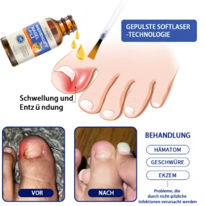 Bee Venom Nail Fungus Treatment Solution - Image 4
