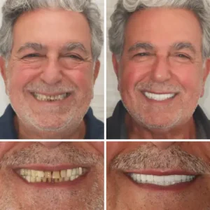 Premium Denture - Image 7