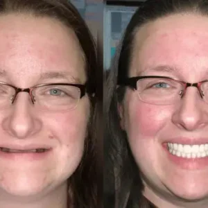Premium Denture - Image 8