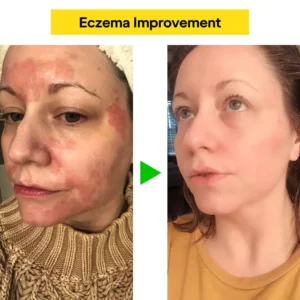 Eczema & Psoriasis Natural Herbal Cream - Image 2