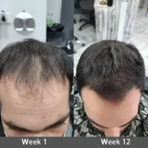 Highly Effective Biotin & Rosemary Hair Growth Serum - Image 5