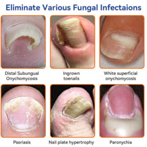 Bee Venom Nail Fungus Treatment Solution - Image 3