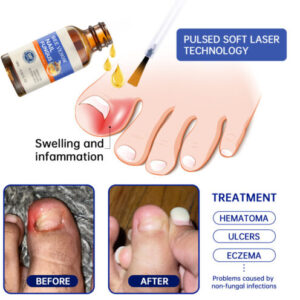 Bee Venom Nail Fungus Treatment Solution - Image 6
