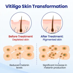 Vitiligo Treatment Spray - Image 3
