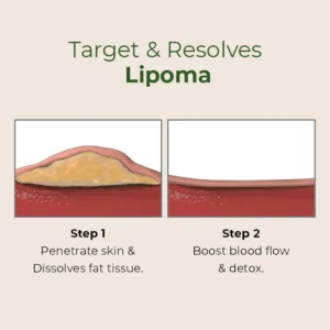 Lipoma Removal Patch - Image 2