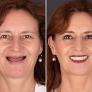 BioFusion Dentures - Image 6