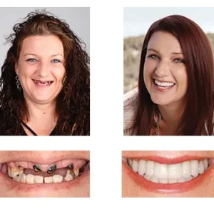 Custom-Fit Functional Dentures - Image 8