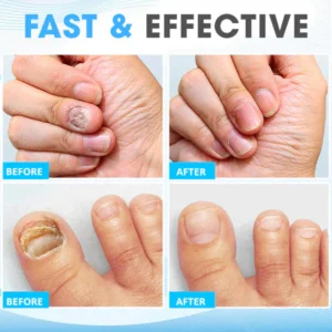 Fungi Treatment Pen - Image 5