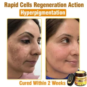 𝐁𝐞𝐞 𝐕𝐞𝐧𝐨𝐦 𝐀𝐥𝐥-𝐢𝐧-𝐎𝐧𝐞 𝐂𝐫𝐞𝐚𝐦–🌸 Anti-aging,Hydrating, Skin Repair, Even Tone, Acne and Dark Spot Treatment, Wart and Mole Removal, Psoriasis Relief - Image 10